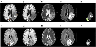 Quantitative evaluation of the influence of multiple MRI sequences and of pathological tissues on the registration of longitudinal data acquired during brain tumor treatment